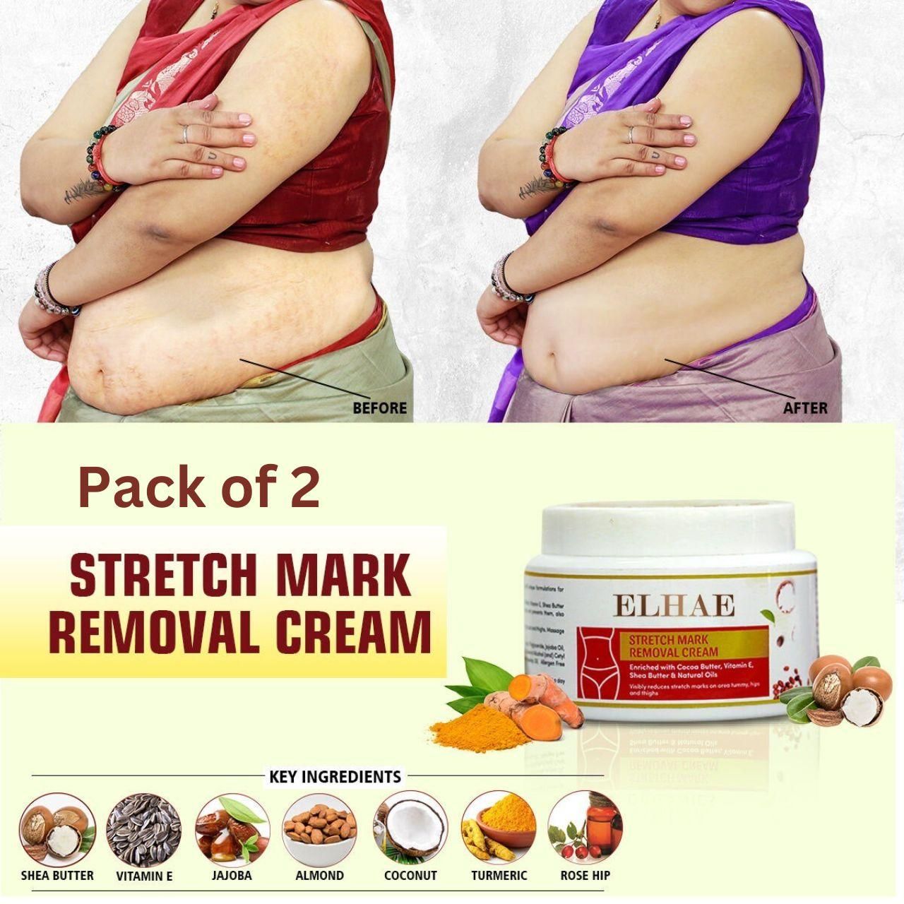 Stretch Mark Remove Cream (BUY 1 GET 1 FREE)